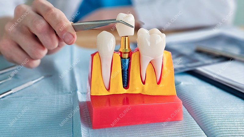 Dental Implant the Better Choice